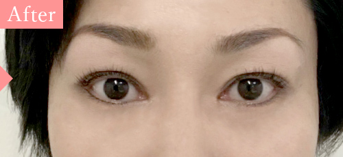 シスアイラッシュセットとアイシャル施術後
